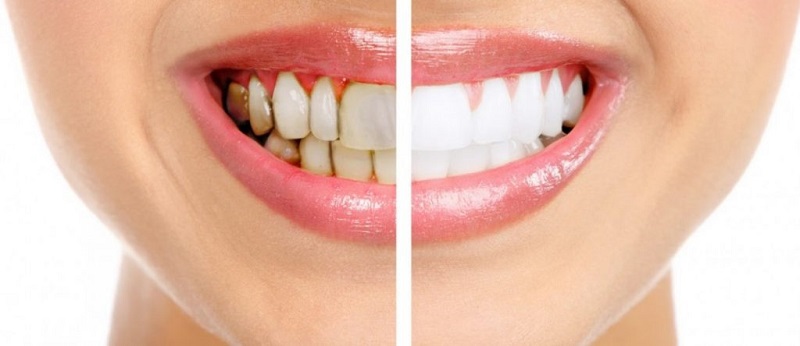 teeth whitening