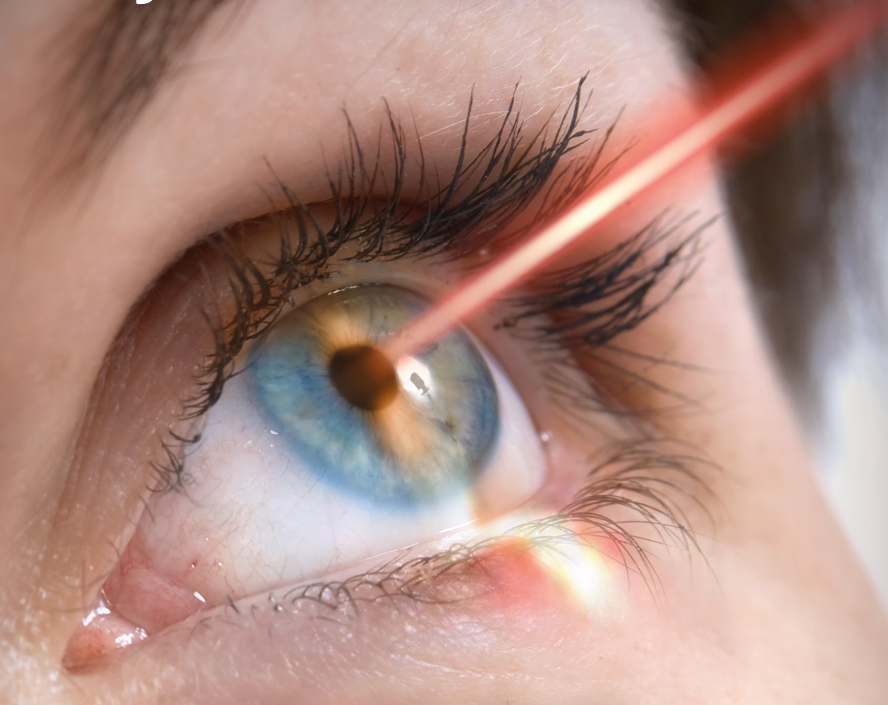 Side Effects of Laser Eye Surgery