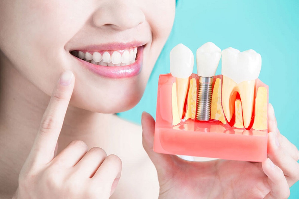 Some Myths About Dental Implants