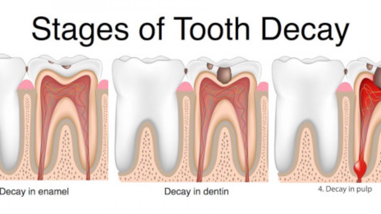 Other Early Stages of Tooth Decay
